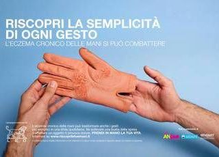 Mani che bruciano e fanno male, al via campagna su eczema cronico Mani che bruciano e fanno male, al via campagna su eczema cronico