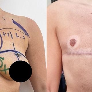 Chirurgia e psicologia insieme: nasce un nuovo modello per le operazioni transgender