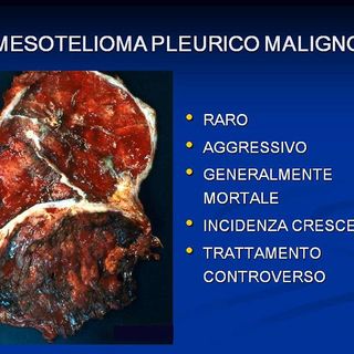Ricerca Università-Ospedale Parini individua farmaci per mesotelioma pleurico
