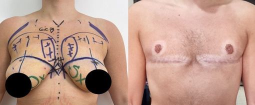 Chirurgia e psicologia insieme: nasce un nuovo modello per le operazioni transgender