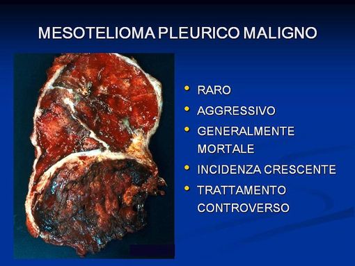 Ricerca Università-Ospedale Parini individua farmaci per mesotelioma pleurico