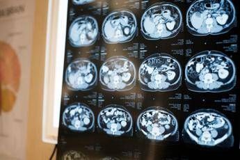 Neurologi: &quot;Noi fondamentali in gestione neoplasie cerebrali&quot;