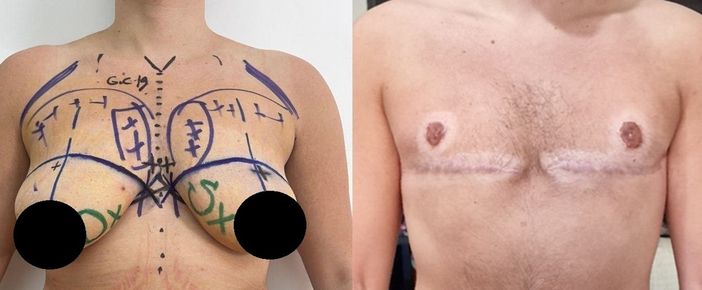 Chirurgia e psicologia insieme: nasce un nuovo modello per le operazioni transgender Chirurgia e psicologia insieme: nasce un nuovo modello per le operazioni transgender