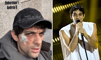 Bresh ferito al volto da un Dobermann, come sta il cantante Bresh ferito al volto da un Dobermann, come sta il cantante