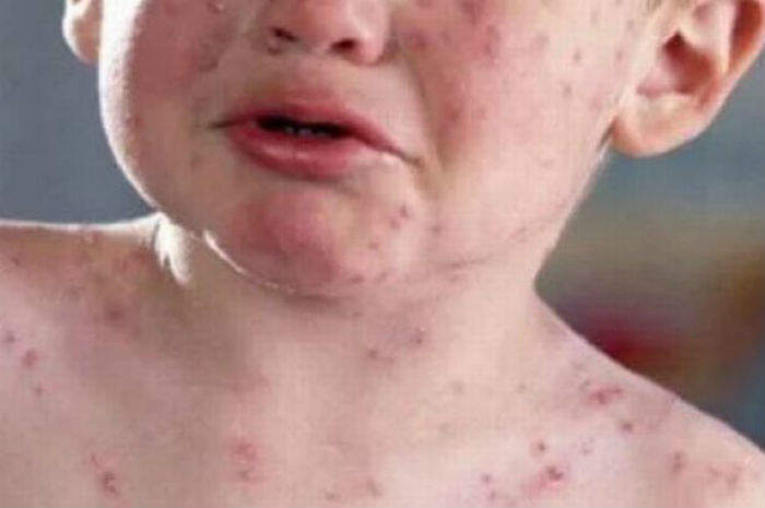 In Valle d’Aosta per mancata vaccinazione asili vietati per 23 bambini In Valle d’Aosta per mancata vaccinazione asili vietati per 23 bambini