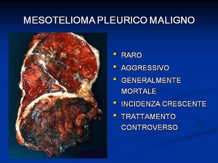 Ricerca Università-Ospedale Parini individua farmaci per mesotelioma pleurico