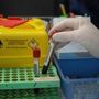 Alzheimer, via libera a test del sangue per diagnosi: cosa significa