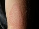 Dermatite atopica e cambi di stagione: come proteggere la pelle