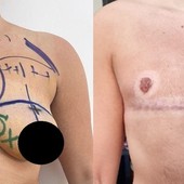 Chirurgia e psicologia insieme: nasce un nuovo modello per le operazioni transgender
