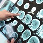 Alzheimer, la malattia inizia 18 anni prima dei sintomi cognitivi