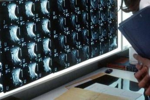 Oltre 500 malattie rare delle ossa, esperti: "Investire in prevenzione e diagnosi"