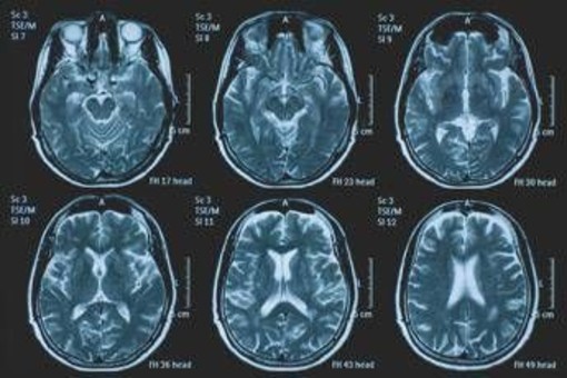 Tumori, glioma pediatrico di basso grado: via libera in Europa a prima terapia mirata