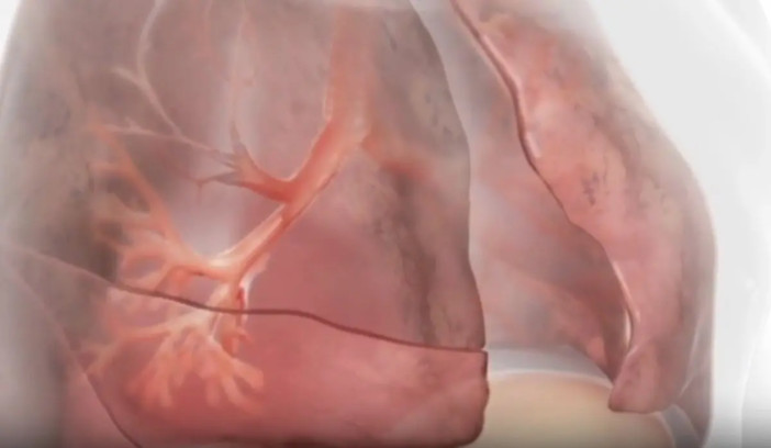 Innovazioni terapeutiche nella BPCO con enfisema Innovazioni terapeutiche nella BPCO con enfisema