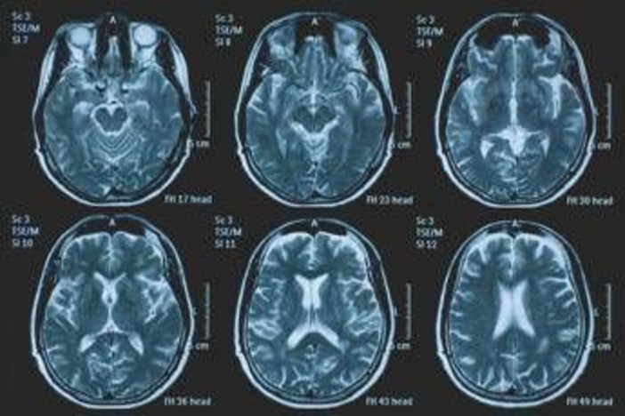 Tumori, glioma pediatrico di basso grado: via libera in Europa a prima terapia mirata