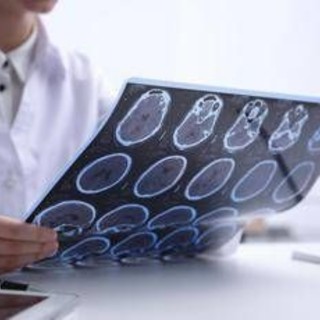 Sin: "Diagnosi più rapide e farmaci innovativi cambiano decorso sclerosi multipla" Sin: "Diagnosi più rapide e farmaci innovativi cambiano decorso sclerosi multipla"