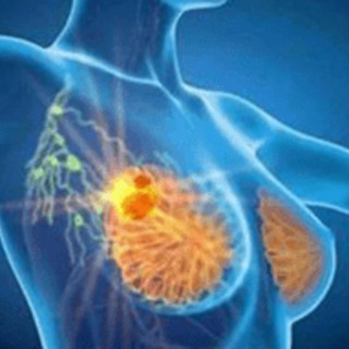 Cancro seno, con profilazione molecolare e terapie target migliori prospettive di cura Cancro seno, con profilazione molecolare e terapie target migliori prospettive di cura