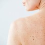 Nei e sole, Sidemast lancia la Giornata della prevenzione dermatologica