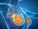 Cancro seno iniziale Her2+, con anticorpo farmaco-coniugato -53% recidiva Cancro seno iniziale Her2+, con anticorpo farmaco-coniugato -53% recidiva