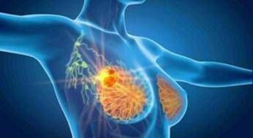 Cancro seno iniziale Her2+, con anticorpo farmaco-coniugato -53% recidiva Cancro seno iniziale Her2+, con anticorpo farmaco-coniugato -53% recidiva