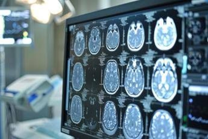 Neoplasie cerebrali, in Italia ogni anno 3mila casi di glioma