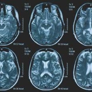 Tumori, glioma pediatrico di basso grado: via libera in Europa a prima terapia mirata