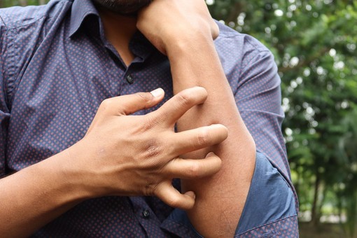 Studio Novartis, l’orticaria cronica spontanea costa 4.200 euro l’anno a paziente Studio Novartis, l’orticaria cronica spontanea costa 4.200 euro l’anno a paziente